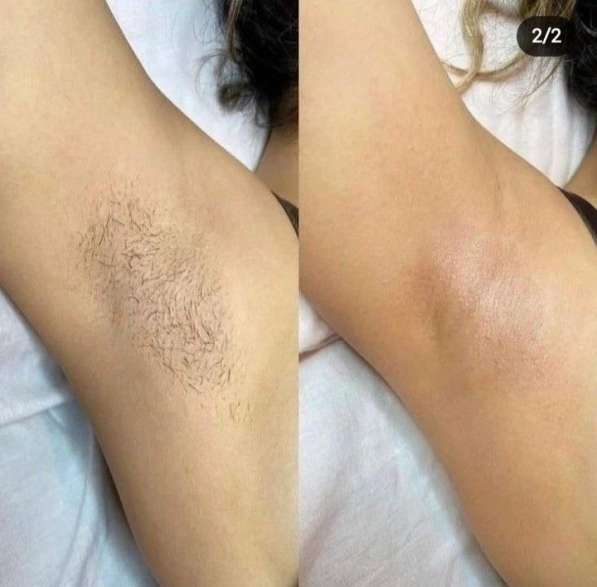 Депиляция - шугаринг, воск в Грозном фото 5