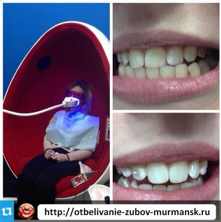 Салон косметического отбеливания зубов в Мурманске фото 6