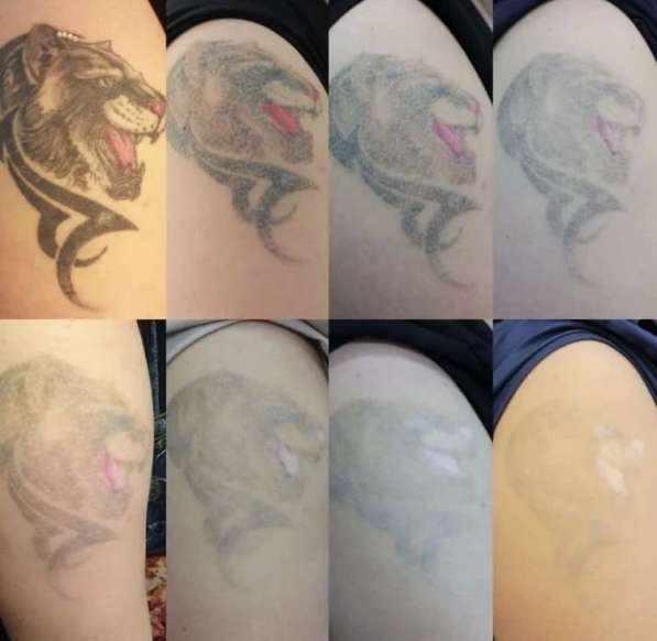 Удалить тату