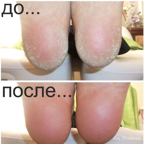 Педикюр для Пожилых Людей и Людей с проблемными ногами в Москве