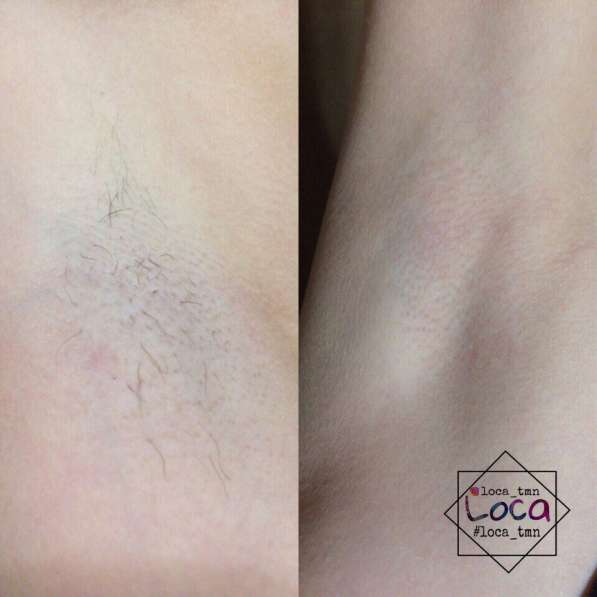 Шугаринг в Тюмени фото 3